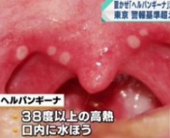 ヘルパンギーナ