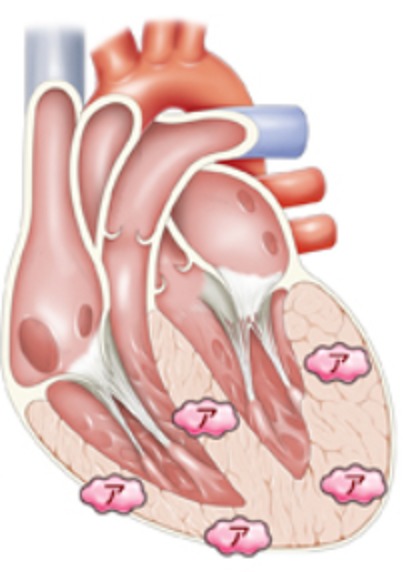 心臓でアミロイドタンパクが集積する場所